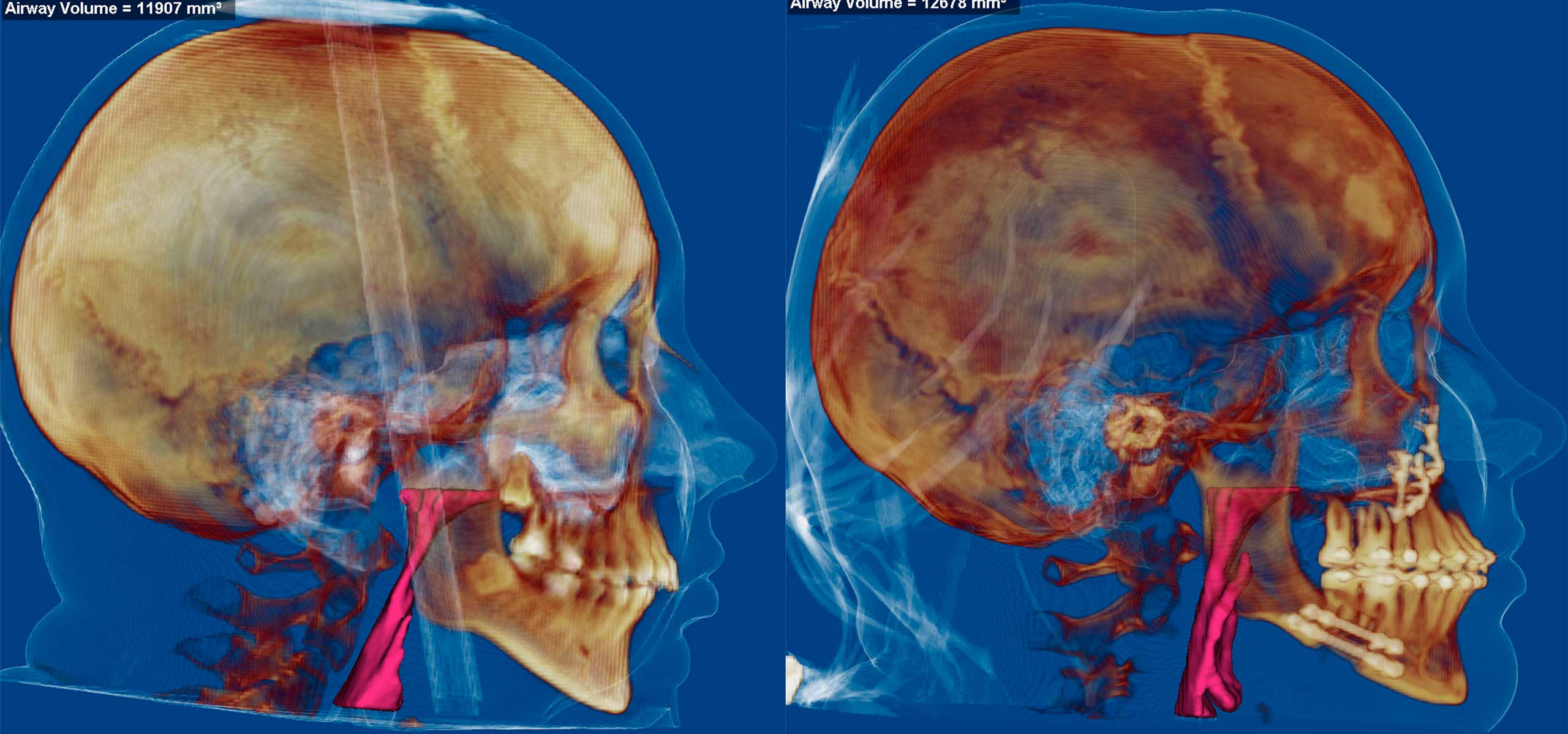 Компьютерная томография лицевого скелета до и после ортогнатической операции с остеосинтезом остеотомированных фрагментов.